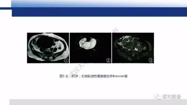 【PPT】卵巢Brenner瘤影像诊断