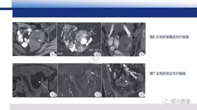 【PPT】卵巢Brenner瘤影像诊断