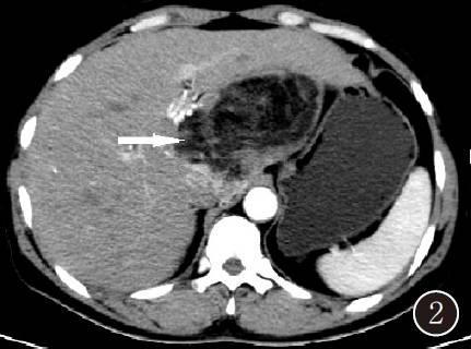 【病例】肝脏血管平滑肌脂肪瘤１例CT