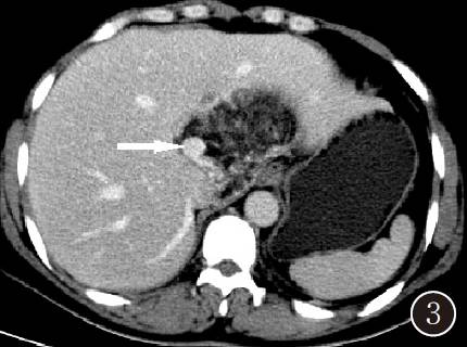 【病例】肝脏血管平滑肌脂肪瘤１例CT