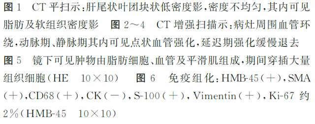 【病例】肝脏血管平滑肌脂肪瘤１例CT