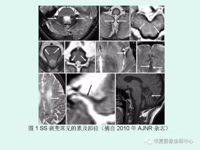 【PPT】中枢神经系统含铁血黄素沉积症