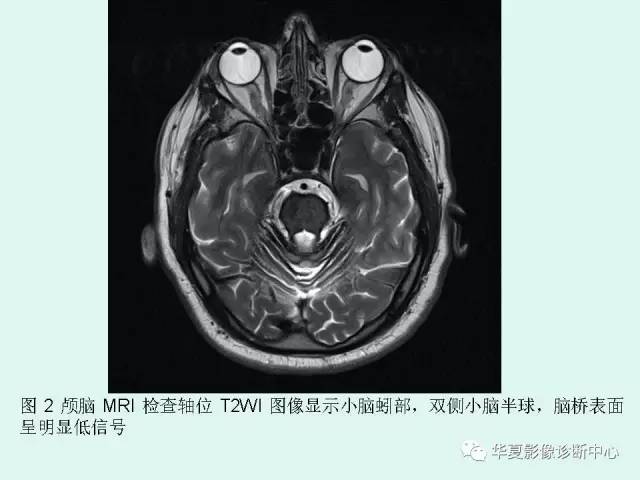 【PPT】中枢神经系统含铁血黄素沉积症