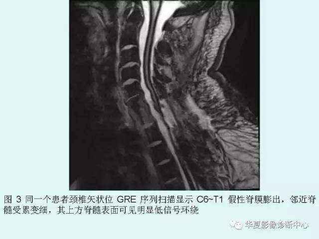 【PPT】中枢神经系统含铁血黄素沉积症