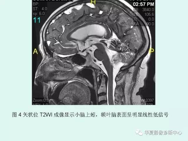 【PPT】中枢神经系统含铁血黄素沉积症