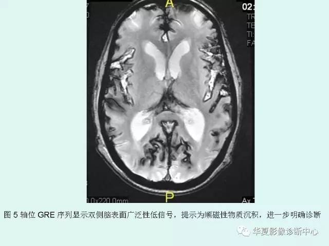 【PPT】中枢神经系统含铁血黄素沉积症