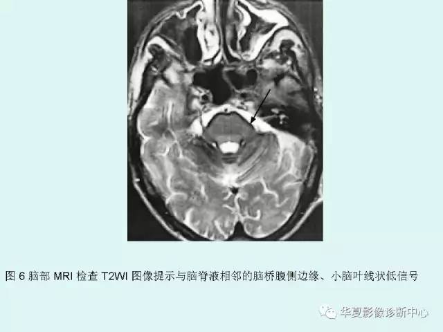 【PPT】中枢神经系统含铁血黄素沉积症