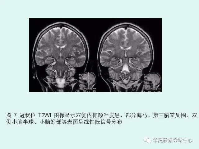 【PPT】中枢神经系统含铁血黄素沉积症