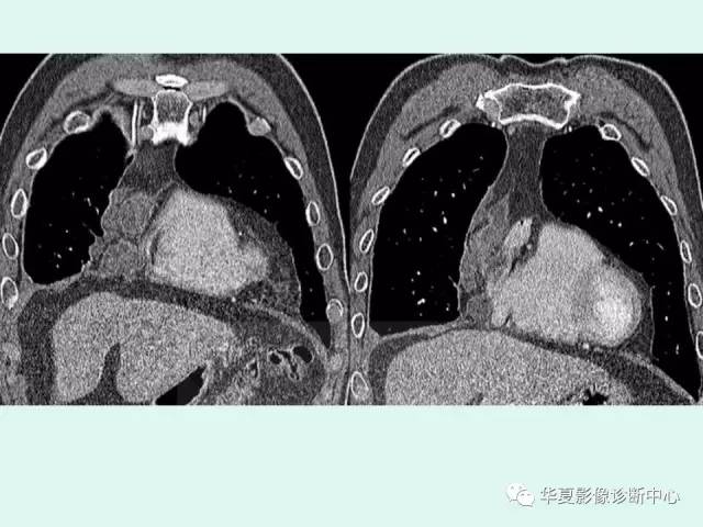 【病例】肺吸虫病1例CT影像表现