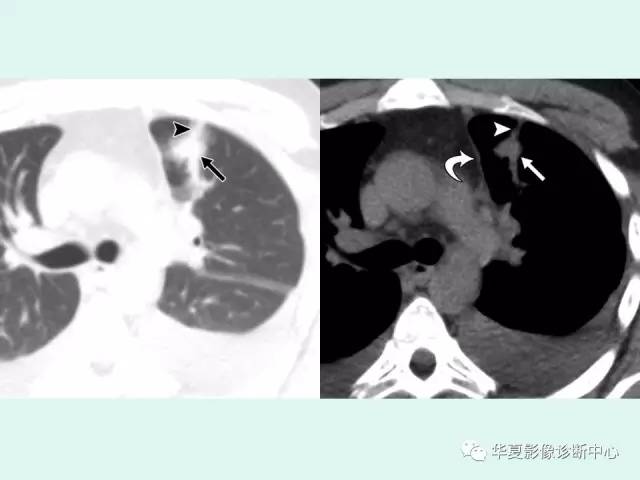 【病例】肺吸虫病1例CT影像表现
