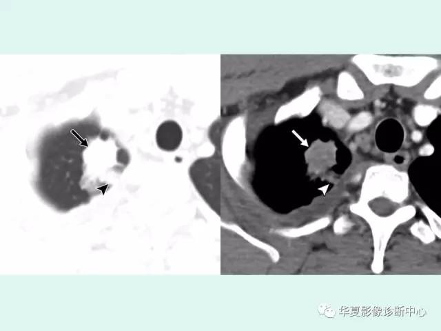 【病例】肺吸虫病1例CT影像表现