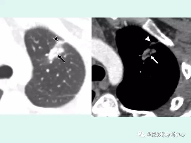 【病例】肺吸虫病1例CT影像表现