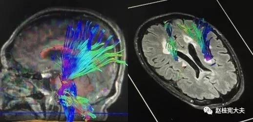 多发性硬化病灶的影像学特点 多发性硬化病灶的影像学特点
