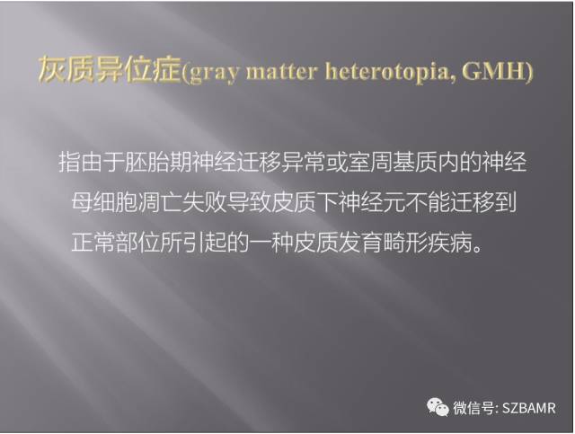 【PPT】灰质异位的MR影像