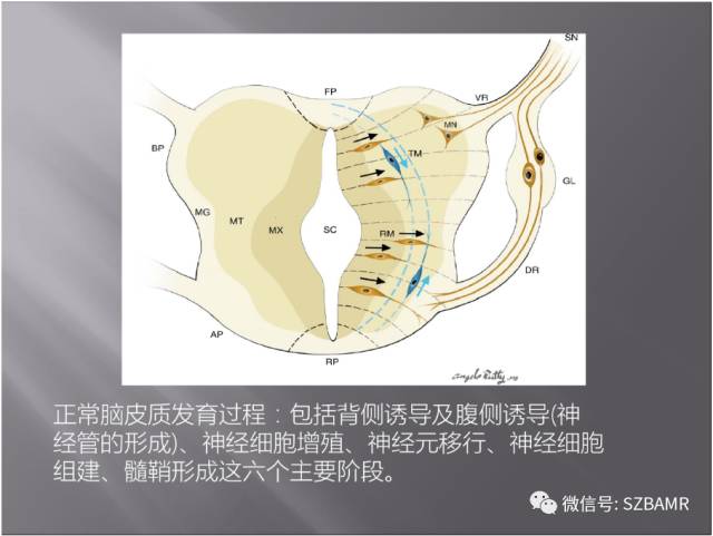 【PPT】灰质异位的MR影像