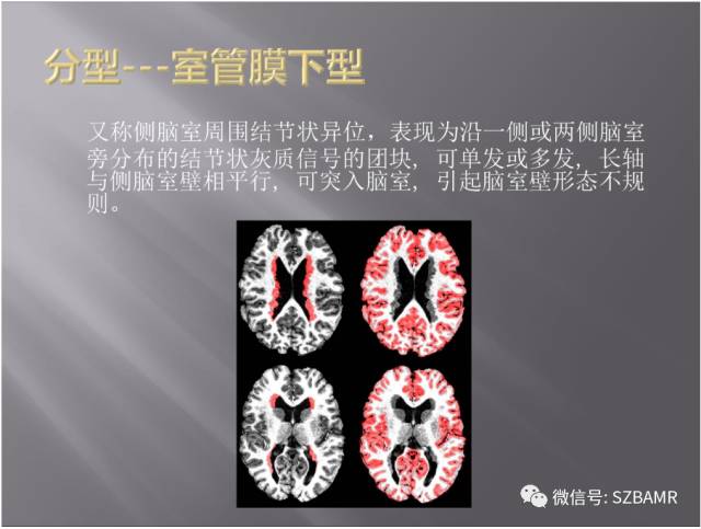 【PPT】灰质异位的MR影像