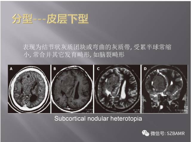 【PPT】灰质异位的MR影像