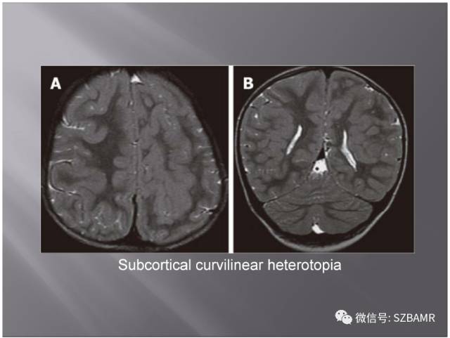 【PPT】灰质异位的MR影像