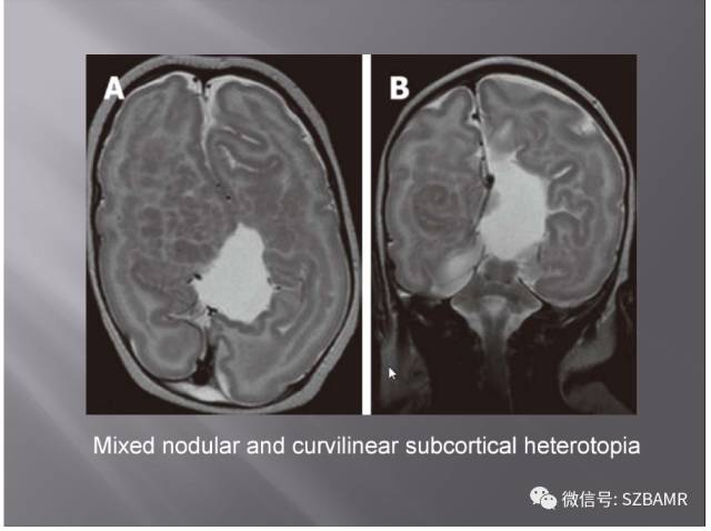 【PPT】灰质异位的MR影像