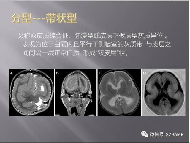 【PPT】灰质异位的MR影像