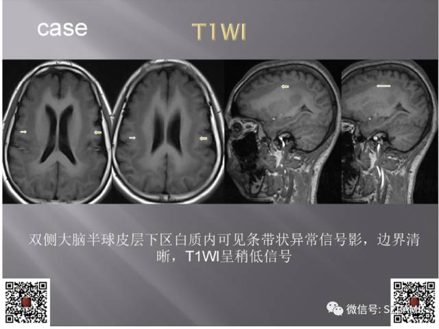 【PPT】灰质异位的MR影像