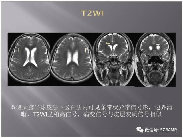 【PPT】灰质异位的MR影像
