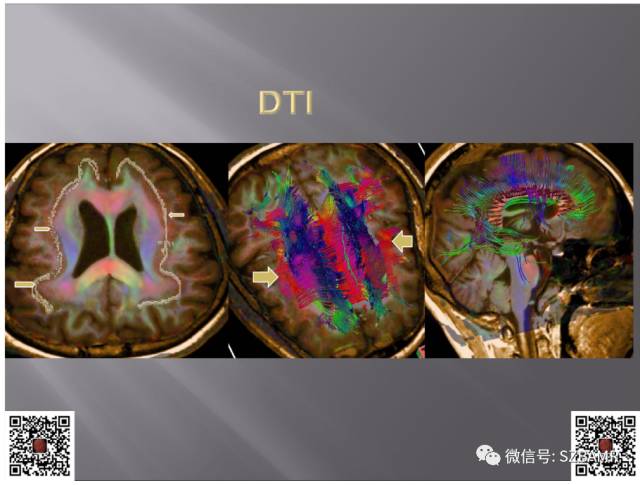 【PPT】灰质异位的MR影像
