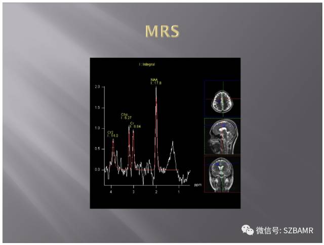 【PPT】灰质异位的MR影像