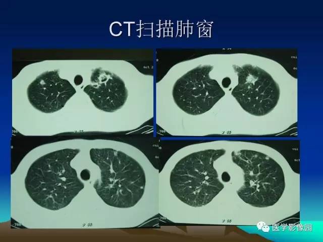 【病例】肺曲霉菌病1例CT