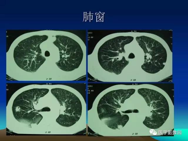 【病例】肺曲霉菌病1例CT