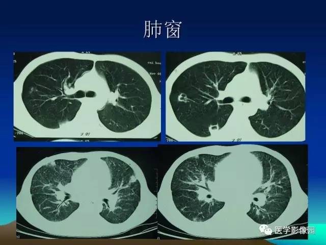【病例】肺曲霉菌病1例CT
