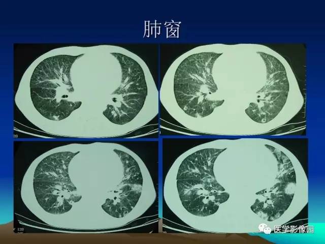【病例】肺曲霉菌病1例CT