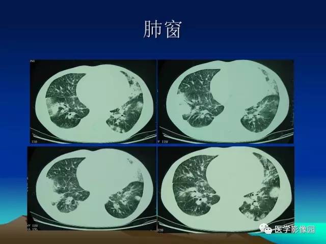 【病例】肺曲霉菌病1例CT