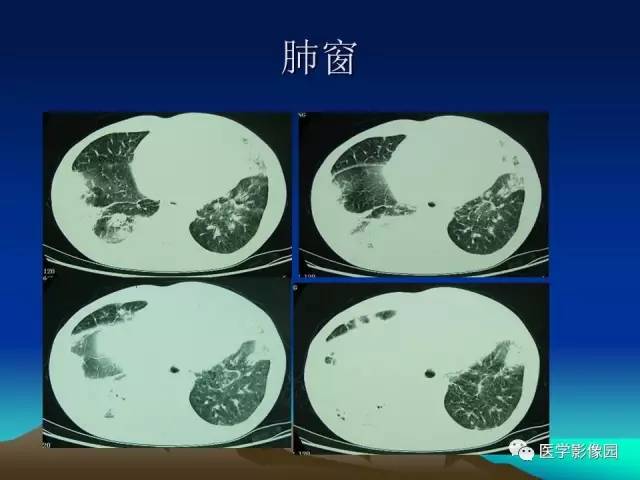 【病例】肺曲霉菌病1例CT