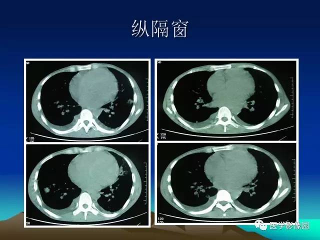 【病例】肺曲霉菌病1例CT