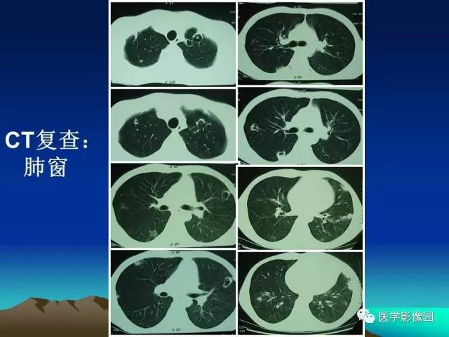 【病例】肺曲霉菌病1例CT