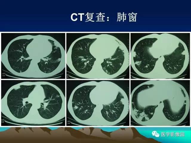【病例】肺曲霉菌病1例CT
