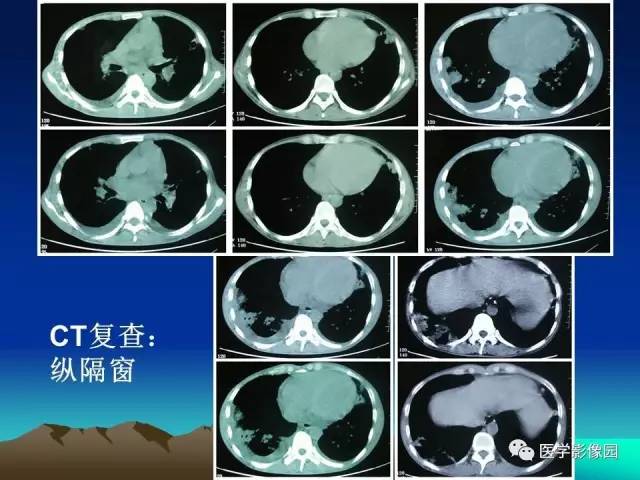 【病例】肺曲霉菌病1例CT