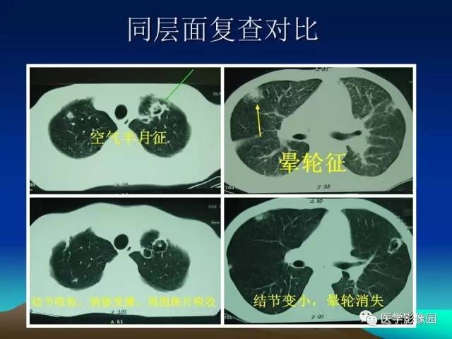 【病例】肺曲霉菌病1例CT