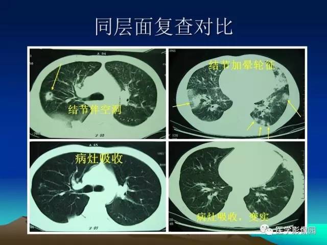 【病例】肺曲霉菌病1例CT