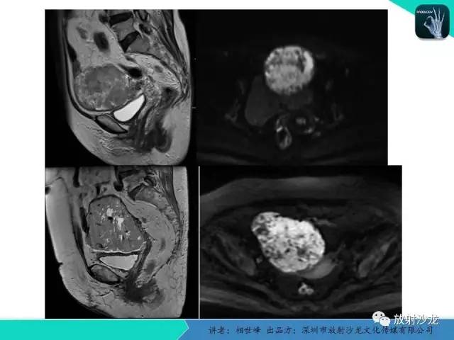 【PPT】女性盆腔非生殖系统肿瘤 的MRI诊断
