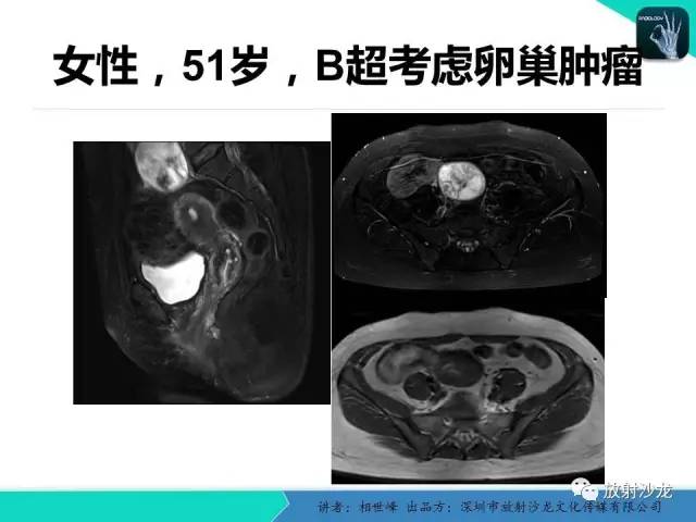 【PPT】女性盆腔非生殖系统肿瘤 的MRI诊断