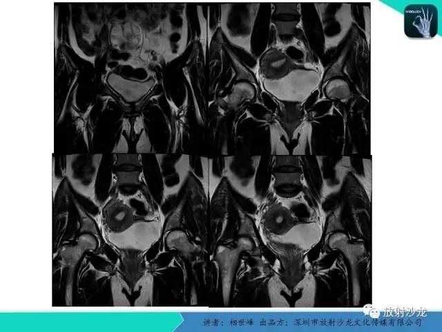 【PPT】女性盆腔非生殖系统肿瘤 的MRI诊断