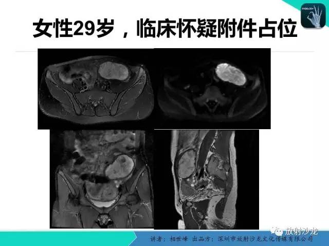 【PPT】女性盆腔非生殖系统肿瘤 的MRI诊断