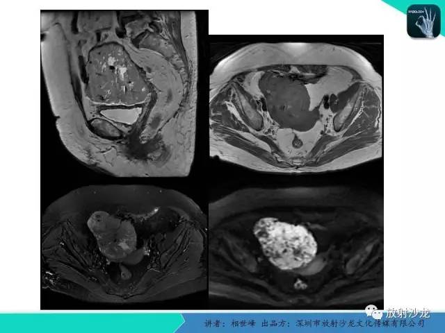 【PPT】女性盆腔非生殖系统肿瘤 的MRI诊断