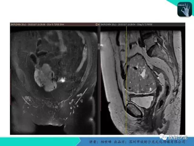 【PPT】女性盆腔非生殖系统肿瘤 的MRI诊断