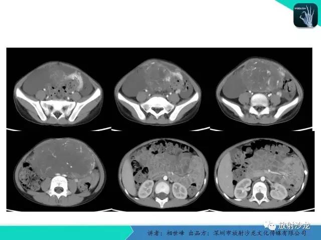 【PPT】女性盆腔非生殖系统肿瘤 的MRI诊断