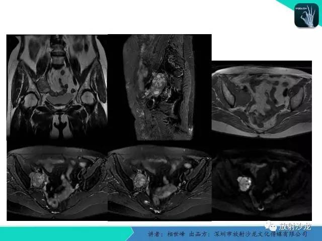 【PPT】女性盆腔非生殖系统肿瘤 的MRI诊断