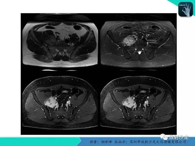 【PPT】女性盆腔非生殖系统肿瘤 的MRI诊断