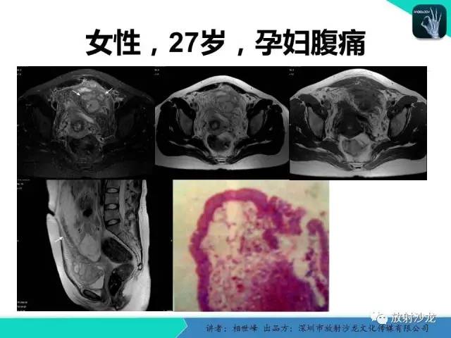 【PPT】女性盆腔非生殖系统肿瘤 的MRI诊断